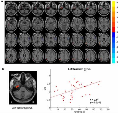 Altered Global Synchronizations in Patients With Parkinson’s Disease: A Resting-State fMRI Study